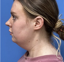 Liposuction Before Photo by Michael Epstein, MD, FACS; Northbrook, IL - Case 50139
