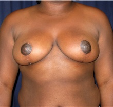 Breast Reduction After Photo by Gary Culbertson, MD, FACS; Sumter, SC - Case 33284
