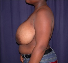 Breast Reduction Before Photo by Gary Culbertson, MD, FACS; Sumter, SC - Case 33284