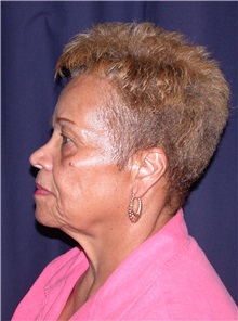 Facelift Before Photo by Gary Culbertson, MD, FACS; Sumter, SC - Case 33289