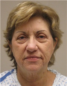 Facelift Before Photo by Gary Culbertson, MD, FACS; Sumter, SC - Case 33290