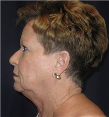 Facelift Before Photo by Gary Culbertson, MD, FACS; Sumter, SC - Case 33294