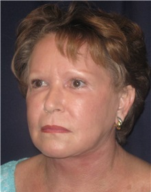 Facelift After Photo by Gary Culbertson, MD, FACS; Sumter, SC - Case 33294