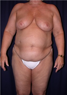 Tummy Tuck Before Photo by Gary Culbertson, MD, FACS; Sumter, SC - Case 33318