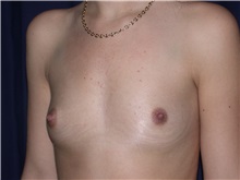 Breast Augmentation Before Photo by Gary Culbertson, MD, FACS; Sumter, SC - Case 33320