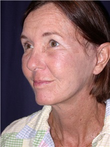 Facelift After Photo by Gary Culbertson, MD, FACS; Sumter, SC - Case 33324