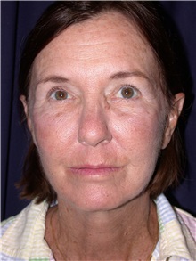 Facelift Before Photo by Gary Culbertson, MD, FACS; Sumter, SC - Case 33324