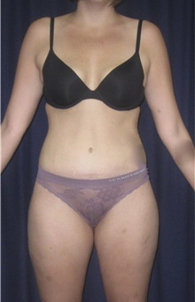 Tummy Tuck After Photo by Gary Culbertson, MD, FACS; Sumter, SC - Case 33325