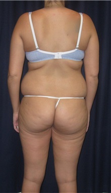 Tummy Tuck Before Photo by Gary Culbertson, MD, FACS; Sumter, SC - Case 33325