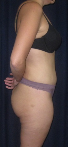 Tummy Tuck After Photo by Gary Culbertson, MD, FACS; Sumter, SC - Case 33325