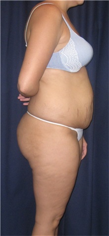 Tummy Tuck Before Photo by Gary Culbertson, MD, FACS; Sumter, SC - Case 33325