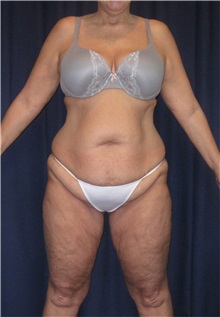Tummy Tuck Before Photo by Gary Culbertson, MD, FACS; Sumter, SC - Case 33326