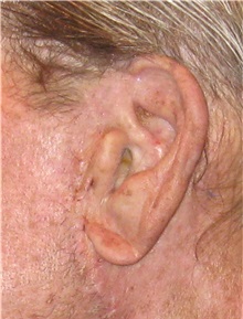 Head and Neck Skin Cancer Reconstruction After Photo by Gary Culbertson, MD, FACS; Sumter, SC - Case 33328