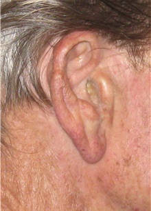 Head and Neck Skin Cancer Reconstruction After Photo by Gary Culbertson, MD, FACS; Sumter, SC - Case 33331