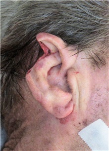 Head and Neck Skin Cancer Reconstruction Before Photo by Gary Culbertson, MD, FACS; Sumter, SC - Case 33331
