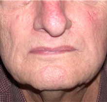 Head and Neck Skin Cancer Reconstruction After Photo by Gary Culbertson, MD, FACS; Sumter, SC - Case 33333
