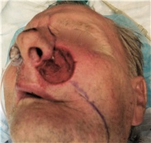 Head and Neck Skin Cancer Reconstruction Before Photo by Gary Culbertson, MD, FACS; Sumter, SC - Case 33333