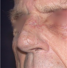 Head and Neck Skin Cancer Reconstruction After Photo by Gary Culbertson, MD, FACS; Sumter, SC - Case 33334