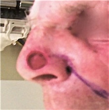 Head and Neck Skin Cancer Reconstruction Before Photo by Gary Culbertson, MD, FACS; Sumter, SC - Case 33334