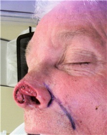 Head and Neck Skin Cancer Reconstruction Before Photo by Gary Culbertson, MD, FACS; Sumter, SC - Case 33336