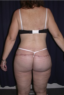 Buttock Lift with Augmentation After Photo by Gary Culbertson, MD, FACS; Sumter, SC - Case 33338