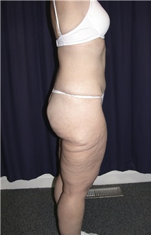 Buttock Lift with Augmentation Before Photo by Gary Culbertson, MD, FACS; Sumter, SC - Case 33338