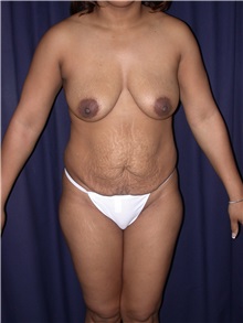 Tummy Tuck Before Photo by Gary Culbertson, MD, FACS; Sumter, SC - Case 33339
