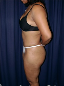Tummy Tuck After Photo by Gary Culbertson, MD, FACS; Sumter, SC - Case 33339