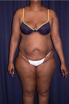 Tummy Tuck Before Photo by Gary Culbertson, MD, FACS; Sumter, SC - Case 33340