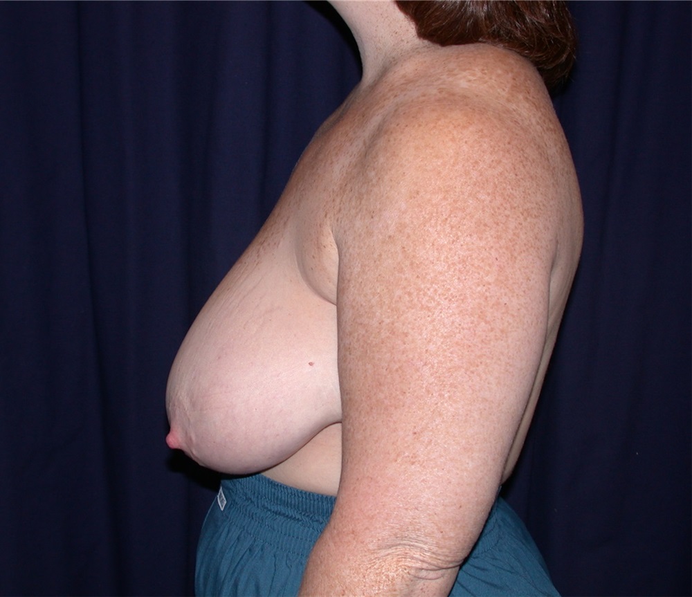 Breast Reduction Before and After Photos by Gary Culbertson, MD, FACS;  Sumter, SC - Case 33341