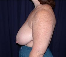 Breast Reduction Before Photo by Gary Culbertson, MD, FACS; Sumter, SC - Case 33341