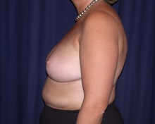 Breast Reduction After Photo by Gary Culbertson, MD, FACS; Sumter, SC - Case 33342