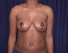 Breast Reduction After Photo by Gary Culbertson, MD, FACS; Sumter, SC - Case 33343
