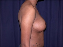 Breast Reduction After Photo by Gary Culbertson, MD, FACS; Sumter, SC - Case 33343