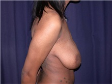 Breast Reduction Before Photo by Gary Culbertson, MD, FACS; Sumter, SC - Case 33343