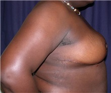 Breast Reduction After Photo by Gary Culbertson, MD, FACS; Sumter, SC - Case 33345