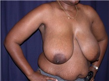 Breast Reduction Before Photo by Gary Culbertson, MD, FACS; Sumter, SC - Case 33346