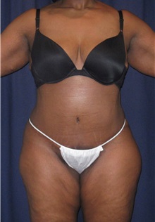 Tummy Tuck After Photo by Gary Culbertson, MD, FACS; Sumter, SC - Case 33449