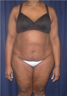 Tummy Tuck Before Photo by Gary Culbertson, MD, FACS; Sumter, SC - Case 33449