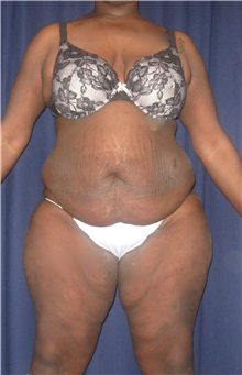 Tummy Tuck Before Photo by Gary Culbertson, MD, FACS; Sumter, SC - Case 33450