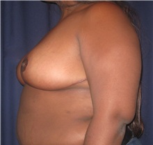 Breast Reduction After Photo by Gary Culbertson, MD, FACS; Sumter, SC - Case 33451