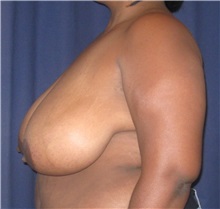 Breast Reduction Before Photo by Gary Culbertson, MD, FACS; Sumter, SC - Case 33451