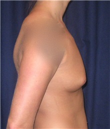 Breast Augmentation Before Photo by Gary Culbertson, MD, FACS; Sumter, SC - Case 33452