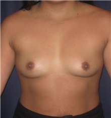 Breast Augmentation Before Photo by Gary Culbertson, MD, FACS; Sumter, SC - Case 33453