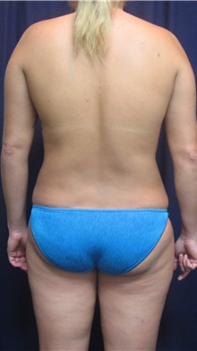 Liposuction After Photo by Gary Culbertson, MD, FACS; Sumter, SC - Case 33454