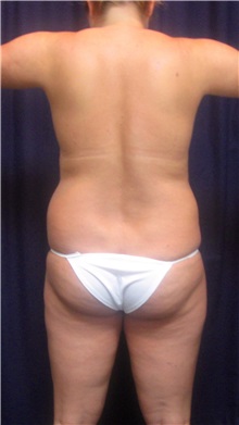 Liposuction Before Photo by Gary Culbertson, MD, FACS; Sumter, SC - Case 33454