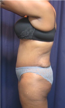 Tummy Tuck After Photo by Gary Culbertson, MD, FACS; Sumter, SC - Case 33455
