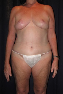 Tummy Tuck After Photo by Gary Culbertson, MD, FACS; Sumter, SC - Case 33457