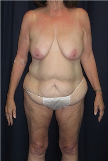 Tummy Tuck Before Photo by Gary Culbertson, MD, FACS; Sumter, SC - Case 33457