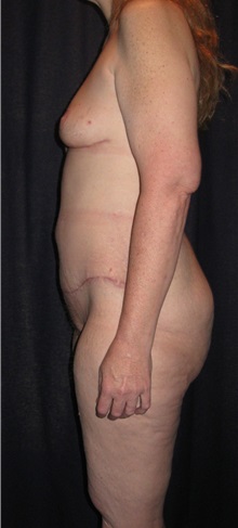 Tummy Tuck After Photo by Gary Culbertson, MD, FACS; Sumter, SC - Case 33458